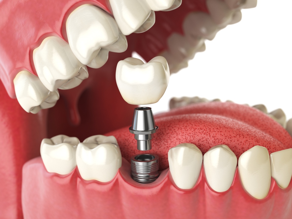 The Benefits of Dental Implants Why They're the Best Option for Tooth Replacement