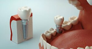 Dental Implants