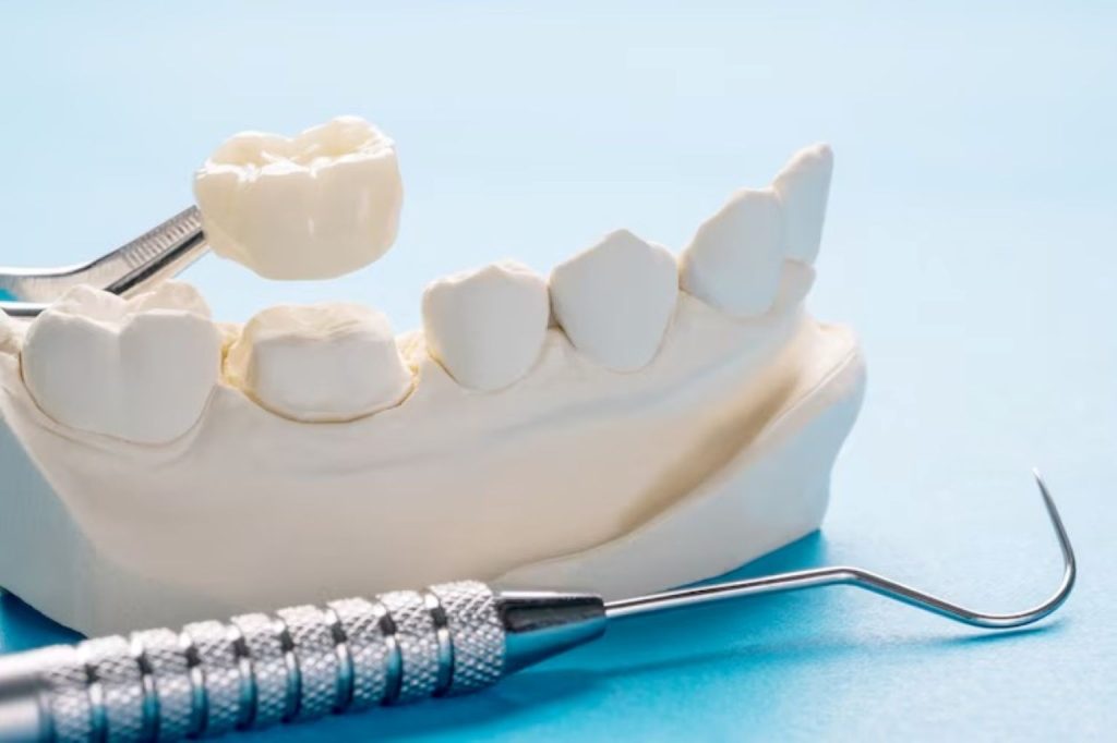 How Long Do Dental Crowns Last? Lifespan, and Care Tips