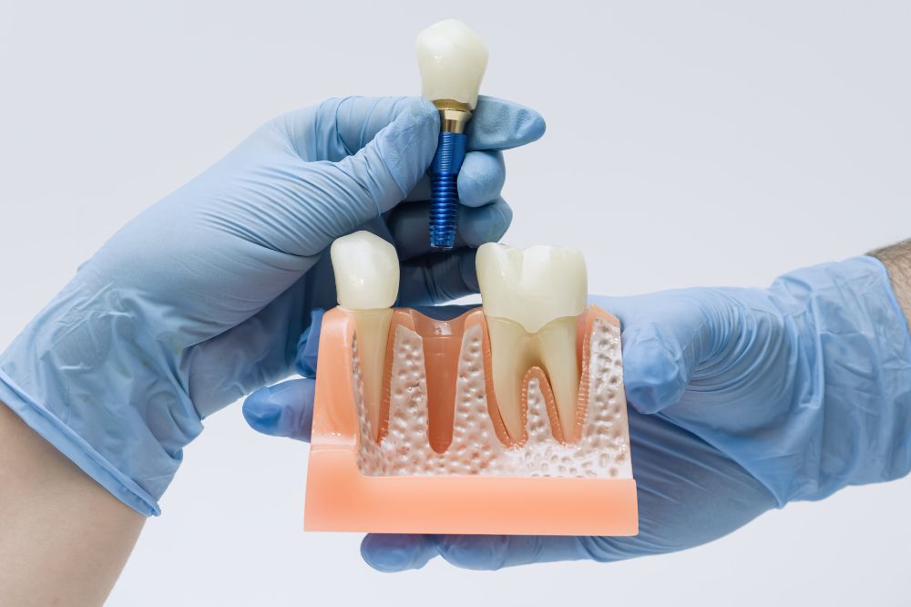 dental implant surgery